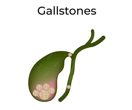 Galstone disease