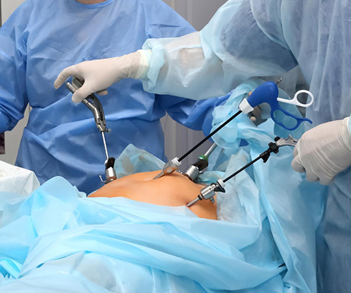 Laparoscopic Surgery